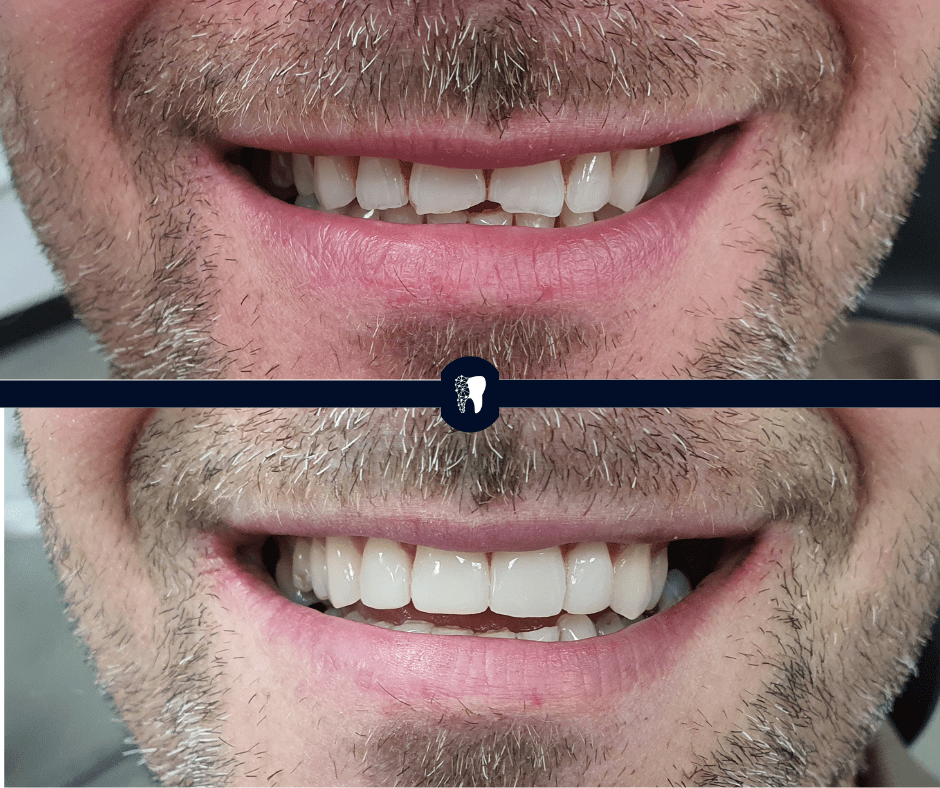 Before and after — smile transformation case 5